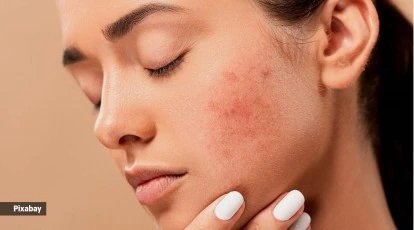 Ayurvedic Treatment For Skin Diseases in Sydney