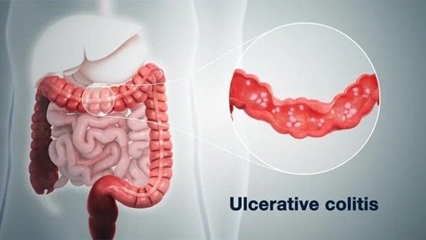 ayurvedic treatments for colitis